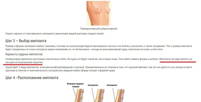 Обзор грудных имплантов (имплантатов молочных желез): форма, профиль, цены  | Интернет-журнал Estetmedicina.ru