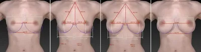 Увеличение груди Киев | Цена 2022 | Маммопластика | Отзывы и Фото