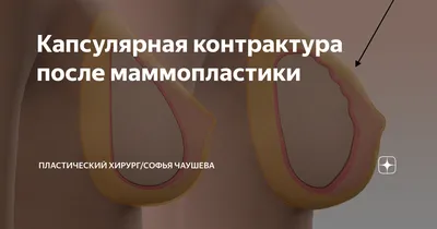 ОНКОЛОГ | МАММОЛОГ | on Instagram: \"📌Анапластическая крупноклеточная  лимфома или имплант-ассоциированная лимфома (ИАЛ) — редкая форма лимфомы,  которая может возникать у некоторых женщин после установки грудных  импланты. Важно понимать, что ИАЛ