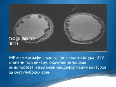 Ультразвуковое исследование гелевых имплантатов молочной железы -  презентация онлайн