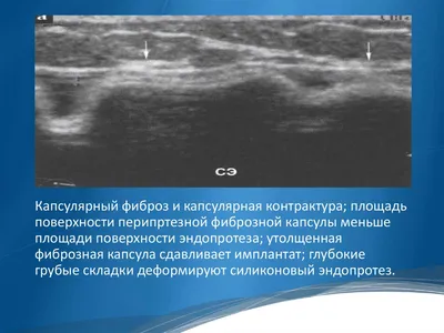 Ультразвуковое исследование гелевых имплантатов молочной железы -  презентация онлайн