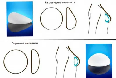 ОДНОМОМЕНТНАЯ РЕКОНСТРУКЦИЯ МОЛОЧНОЙ ЖЕЛЕЗЫ И ПОСЛЕОПЕРАЦИОННАЯ ЛУЧЕВАЯ  ТЕРАПИЯ: РАЗВИТИЕ КАПСУЛЯРНОЙ КОНТРАКТУРЫ – тема научной статьи по  клинической медицине читайте бесплатно текст научно-исследовательской  работы в электронной библиотеке КиберЛенинка