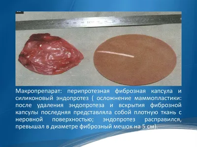 Есть ли срок годности у грудных имплантов