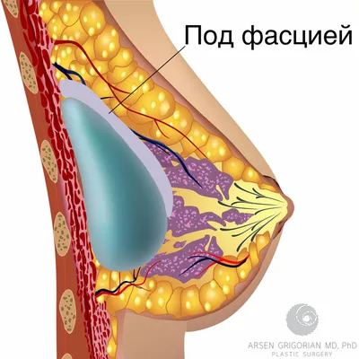 Анимационная деформация молочных желёз после маммопластики (увеличения  груди) | Александр Маркушин пластический хирург