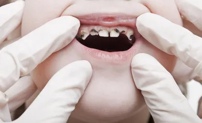 Детская Стоматологическая Клиника \"MamaDentist\" г. Киеве, Украина: Лечение  кариеса передних зубов у детей разного возраста