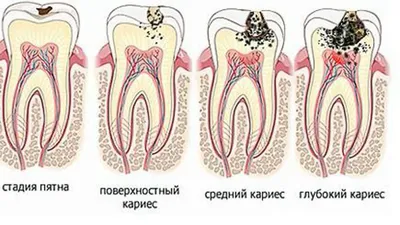 Лечение кариеса у детей в Смоленске в стоматологии Family Smile, цены и  процедуры