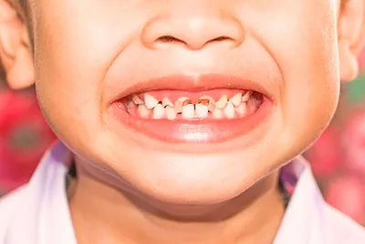 Как лечить зубы ребенку до трех лет? - Евромед Дентал