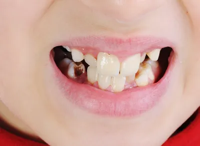 Лечение кариеса у детей: цена в Москве на лечение кариеса молочных и  постоянных зубов в стоматологической клинике