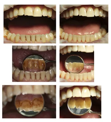 Кариес фото до и после фотографии
