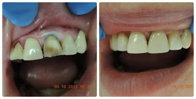 Лечение кариеса зубов, цена в Московской клинике