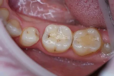 Лечение кариеса: выполненная работа с фото до и после в стоматологии OneDent