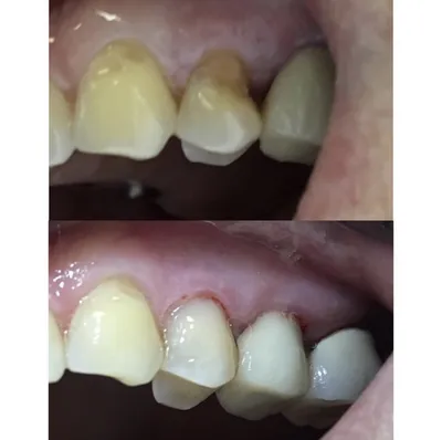 Глубокий кариес, 47 зуб | Примеры работ - фото до и после