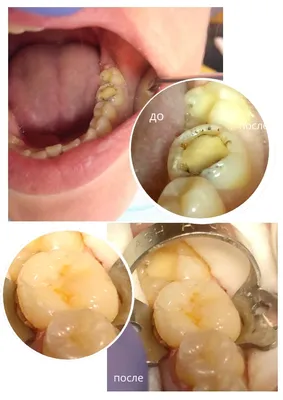 До и после, вроде нормальный 26й зуб, но под эмалью бывают интересные  моменты...кариес(фото в карусели) по показаниям в этом случае пломба.… |  Instagram