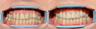 Лечение кариеса | Стоматология в Запорожье Dental Studio