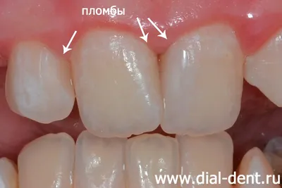 Удаление кариозного процесса и реставрация зуба фотополимерным материалом |  Корона Стом