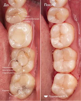 Фото до и после: лечение глубокого кариеса под микроскопом - Happy Dents