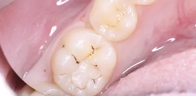 Кариес передних зубов – лечение перед установкой брекетов
