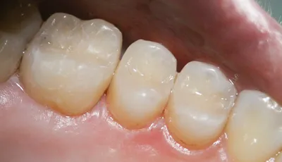 Терапия | Сеть стоматологических клиник Ренидент