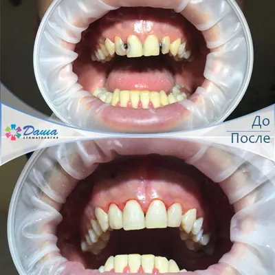 Лечение кариеса и реставрация передних зубов - примеры работ стоматологии  AVS clinic в Санкт-Петербурге
