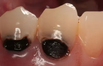 Лечение вторичного кариеса фото до и после Мытищи — Мытищи цена и отзывы  стоматологии Best Family