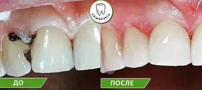 Лечение кариеса зубов в Волгограде в клинике ДАША на Спартановке