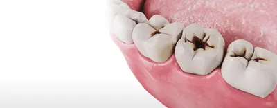 Средний кариес: симптомы и методы лечения постоянных зубов