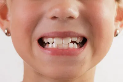 Лечение кариеса молочных зубов у детей в Томске