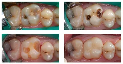 Вторичный кариес | Симптомы, лечение, профилактика | Клиника семейной  стоматологии Дока-Дент