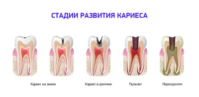 Острый кариес: симптомы, причины, лечение, профилактика, фото острого  кариеса, цены в Москве