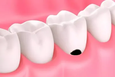 Кариес зубов — причины возникновения, стадии развития и факторы риска
