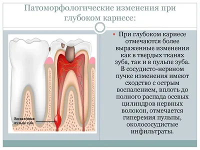 Кариес у детей (лечение в Киеве, цены) - фото, причины