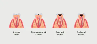 Кариес корня зуба- симптомы, причины, методы лечения кариеса зуба