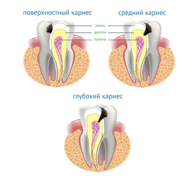 Кариес