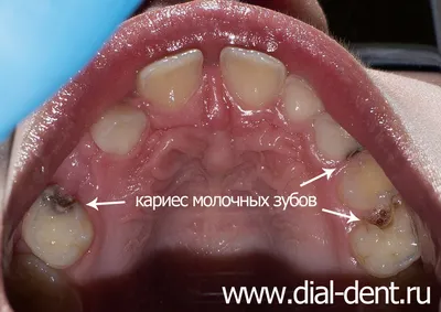 Кариес у детей: Лечения кариеса молочных зубов в Киеве