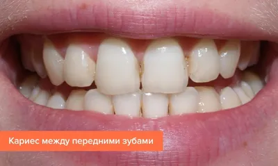Лечение молочных зубов у детей в Санкт-Петербурге, цены в детской  стоматологии «Жемчужина Севера»
