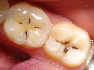 Пришеечный кариес фото, как лечить, причины возникновения | Dental Art