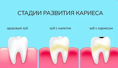 Кариес у детей: Лечения кариеса молочных зубов в Киеве