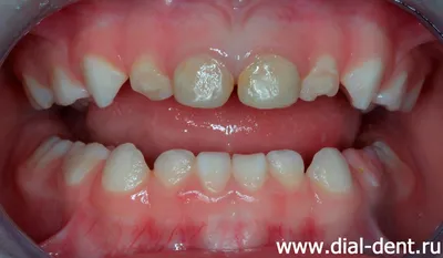 Лечение кариеса у детей в Смоленске в стоматологии Family Smile, цены и  процедуры