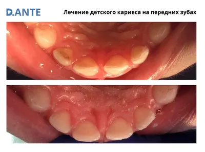 Кариес молочных зубов у детей | TopDent | Дзен