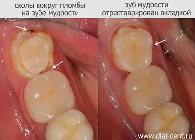 Лечение зуба мудрости, поврежденного кариесом