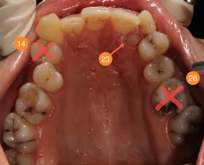 История одной улыбки или рассказ о том как даже «зуб мудрости» пригодился  :: NORD DENTAL — сеть клиник семейной стоматологии на севере Петербурга