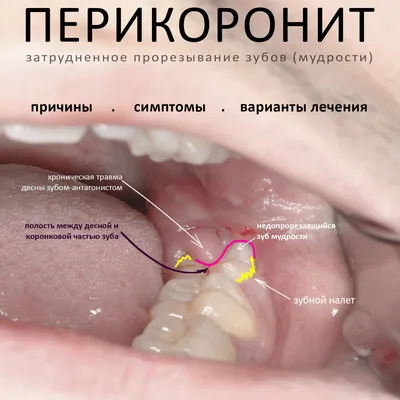 зубы мудрости — CLINICIN.RU