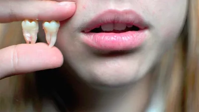 Зуб мудрости с кариесом - лучше удалить или лечить