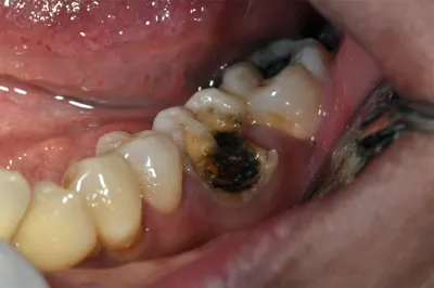 Кариес зуба мудрости - лечить или удалять? Возможные осложнения, как снять  зубную боль