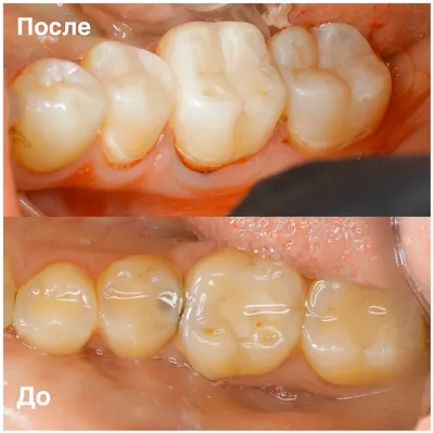 Фото работ до и после лечения контактного кариеса 🚩 Стоматология
