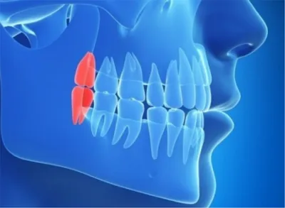 Зубы мудрости и показания к удалению | Cтоматология Люксар