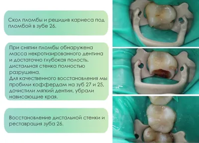 Лечение кариеса зубов в Москве – стоматология \"Зуб Лечить!\"