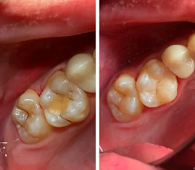 Кариес дентина 26, 27 зубов, до и после лечения - MagicDent