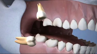 Зубы мудрости - нарушение прикуса и прорезывание восмерок - удалять их или  нет?