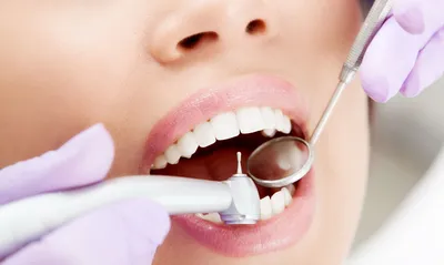 Методы лечение глубокого кариеса зубов, как вылечить кариес
